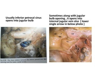 The Petro-occipital Fissure- contains
IPS
 