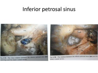 Exocranial & Endocranial views of Jugular Foramen : Within the JF
area 2 venous compartement can be identified: a large postero-
lateral_SIGMOID_venous channel and a small antero-medial_PETROSAL_venous
channel which can receive the drainage of the inferior petrosal sinus (IPS). An
intermediary neural compartment is located between the venous ones and houses
lower cranial nerves (IX, X, XI).
CC carotid canal, CR carotid ridge, ESF endolymphatic sac fossa, FS foramen spinosum, IAM internal acoustic
meatus, JT jugular tubercle, OC occipital condyle, PCF petroclival fi ssure, SAF subarcuate fossa, SP styloid
process, SSG sigmoid sinus groove, TB tympanic bone, VPTB vaginal process of the tympanic bone, white
arrow intrajugular process of the temporal bone, red arrow external ori fi ce of the hypoglossal canal, violet
arrow petroclival fi ssure, blue-sky arrow tubal isthmus, black arrow endocranial orifice of the hypoglossal
canal, orange arrow trigeminal impression, green arrow pyramidal fossa, black asterisks intrajugular ridge,
black circle intrajugularprocess of the occipital bone
 