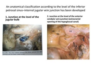 Inferior petrosal sinus
 