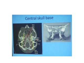 3. Junction at the level of the
lower extracranial jugular vein
• CoC - level of the condylar
canal
• IJV- internal jugular vein
• JF- level of the jugular
foramen
• SS- sigmoid sinus
• VVP- vertebral venous
plexus
 