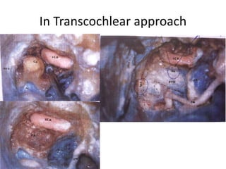 4. Multiple junctions: upper junction at the level of the jugular bulb and
lower junction at the level of the anterior condylar vein
a )Multiple upper junctions at the level of the jugular bulb (JB).
b )Multiple junctions: upper junctions at the level of the jugular bulb and lower
junction at the level of the anterior condylar vein.
c) No connection between the internal petrosal sinus and the internal jugular vein. The
sinus drains in the vertebral venous plexus.
 