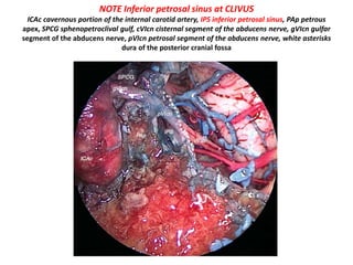 In infratemporal fossa [=intact
cochlear approach –
Dr.Morwani ] type B
approach
See IPS in Kawase approach
 