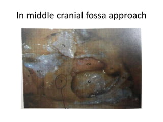 Right sided anterior petrosectomy on a cadaver dissection: intradural exposure
and operative field. PCA Petrous carotid artery; DPA drilled petrous apex; IPS
inferior petrosal sinus; BA basilar artery; VI 6th cranial nerve; AICA anterior inferior
cerebellar artery; P pons; V 5th cranial nerve
 