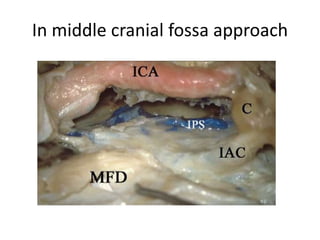 NOTE Inferior petrosal sinus at CLIVUS
ICAc cavernous portion of the internal carotid artery, IPS inferior petrosal sinus, PAp petrous
apex, SPCG sphenopetroclival gulf, cVIcn cisternal segment of the abducens nerve, gVIcn gulfar
segment of the abducens nerve, pVIcn petrosal segment of the abducens nerve, white asterisks
dura of the posterior cranial fossa
 