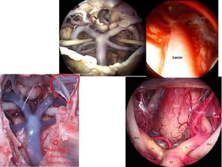 3rd nerve is sandwiched between posterior cerebral artery &
superior cerebellar artery
 