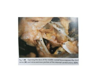 3rd nerve is sandwiched between posterior cerebral
artery & superior cerebellar artery
Through endoscopic lateral skull
base
Through endoscopic anterior
skull base
 