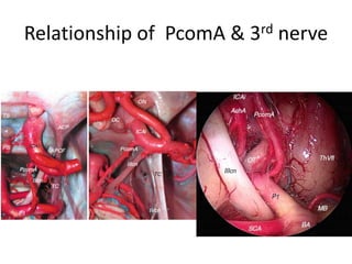 P1 in relation to 3rd nerve P2 in relation to 3rd nerve
 