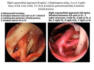 In parasellar pituitary 3rd n & 4th n & Pcom present
in Postero-superior cavernous compartment
 