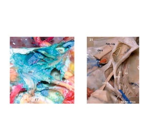 Relationship of PcomA & 3rd nerve
 