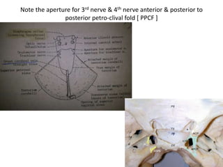 Relationship of PcomA & 3rd nerve
 