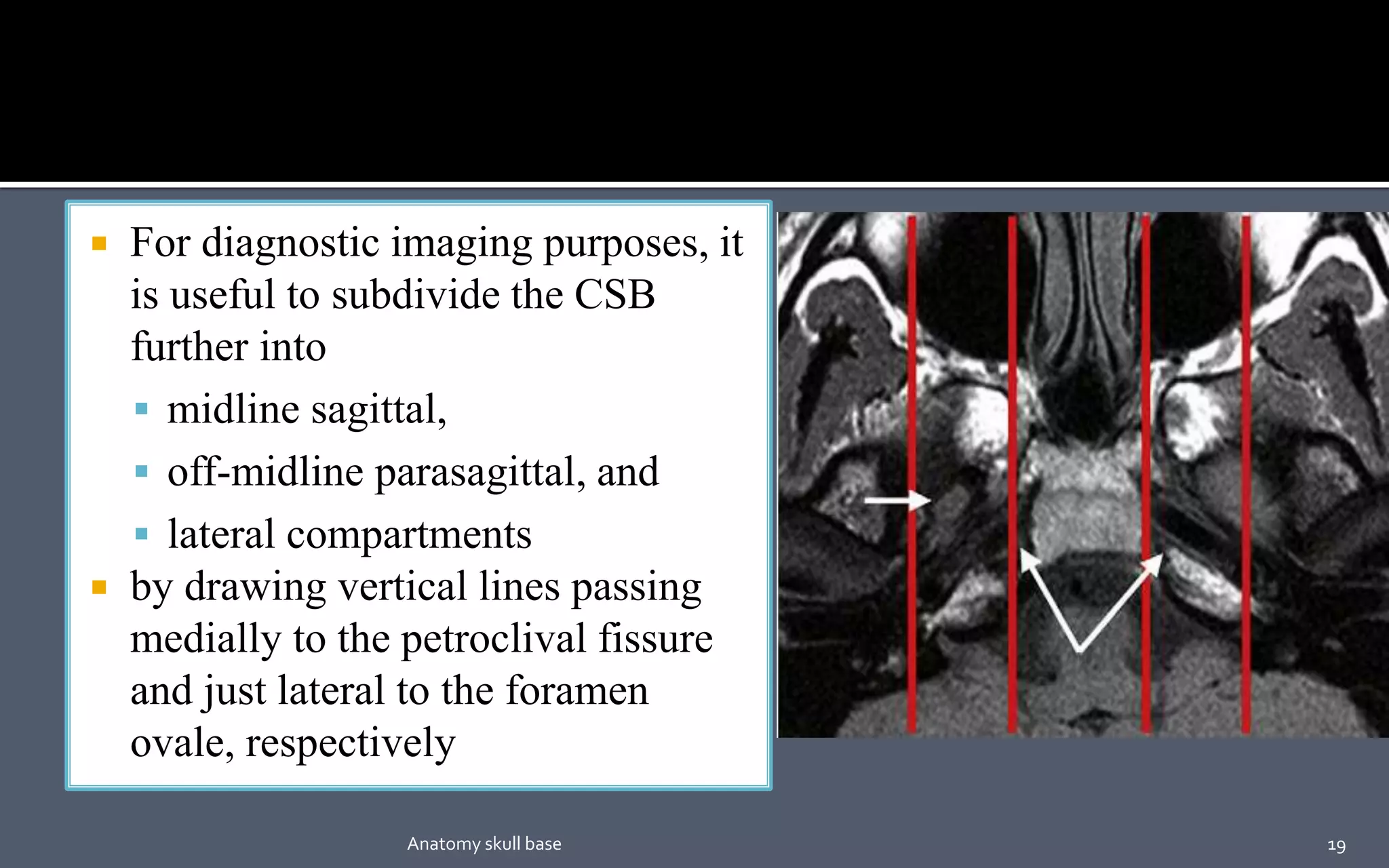  For diagnostic imaging purposes, it
is useful to subdivide the CSB
further into
 midline sagittal,
 off-midline parasagittal, and
 lateral compartments
 by drawing vertical lines passing
medially to the petroclival fissure
and just lateral to the foramen
ovale, respectively
19Anatomy skull base
 