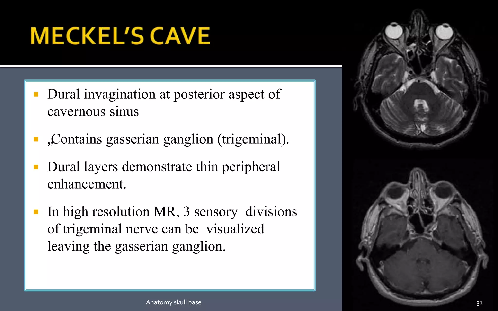  Dural invagination at posterior aspect of
cavernous sinus
 „Contains gasserian ganglion (trigeminal).
 Dural layers demonstrate thin peripheral
enhancement.
 In high resolution MR, 3 sensory divisions
of trigeminal nerve can be visualized
leaving the gasserian ganglion.
31Anatomy skull base
 
