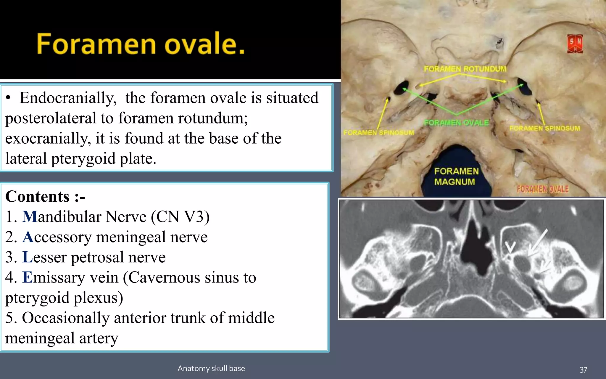 • Endocranially, the foramen ovale is situated
posterolateral to foramen rotundum;
exocranially, it is found at the base of the
lateral pterygoid plate.
Contents :-
1. Mandibular Nerve (CN V3)
2. Accessory meningeal nerve
3. Lesser petrosal nerve
4. Emissary vein (Cavernous sinus to
pterygoid plexus)
5. Occasionally anterior trunk of middle
meningeal artery
37Anatomy skull base
 