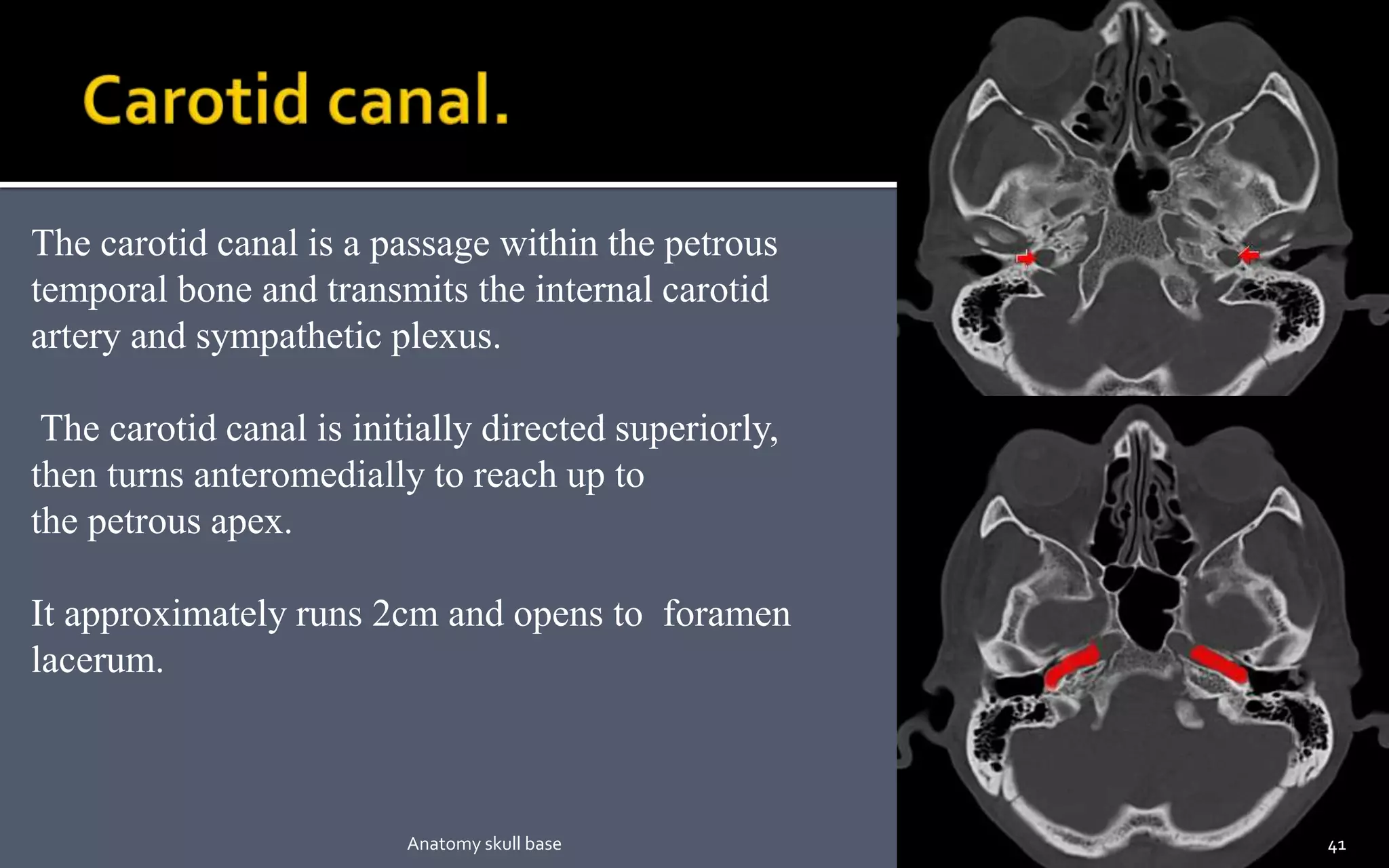 The carotid canal is a passage within the petrous
temporal bone and transmits the internal carotid
artery and sympathetic plexus.
The carotid canal is initially directed superiorly,
then turns anteromedially to reach up to
the petrous apex.
It approximately runs 2cm and opens to foramen
lacerum.
41Anatomy skull base
 
