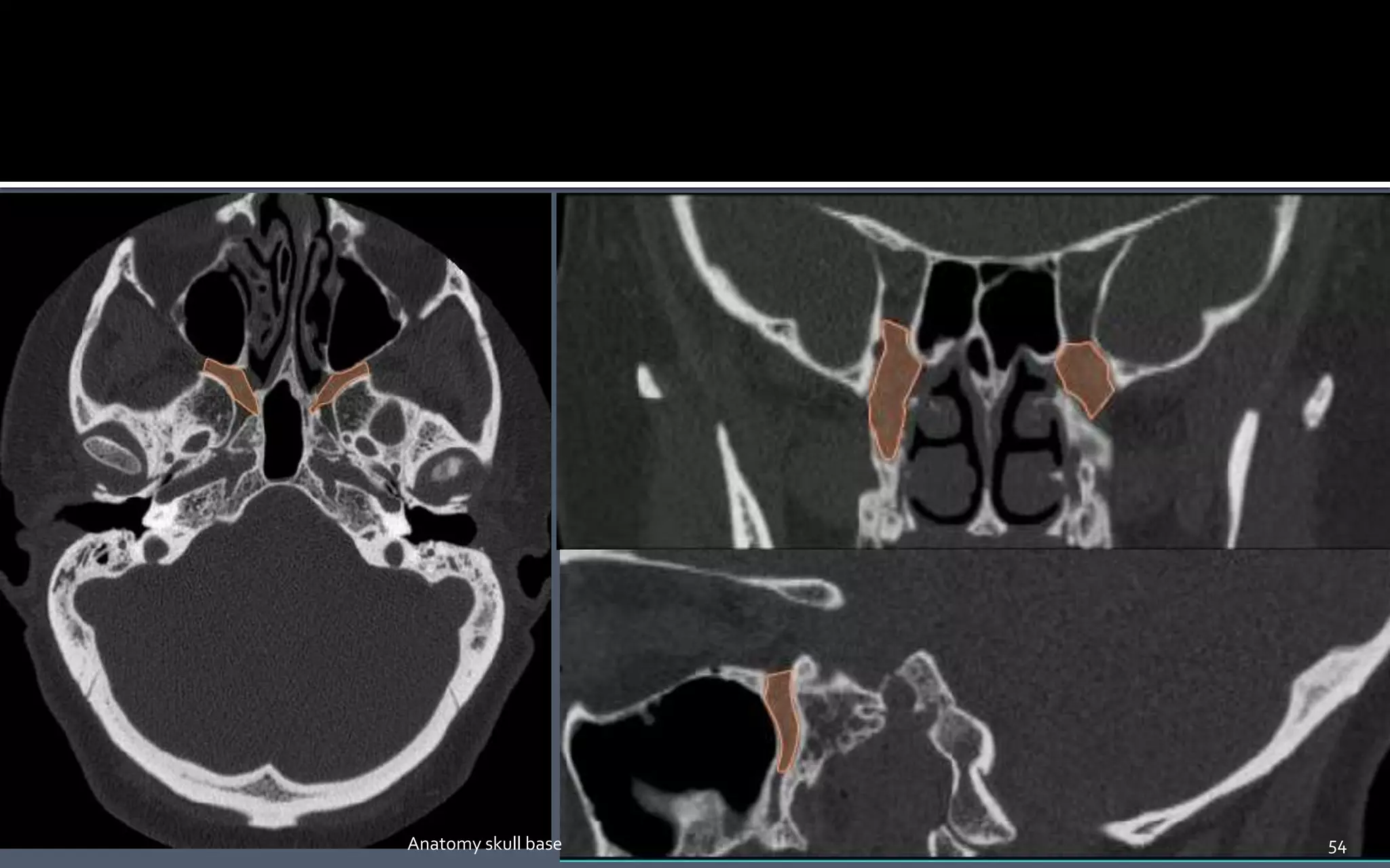 54Anatomy skull base
 