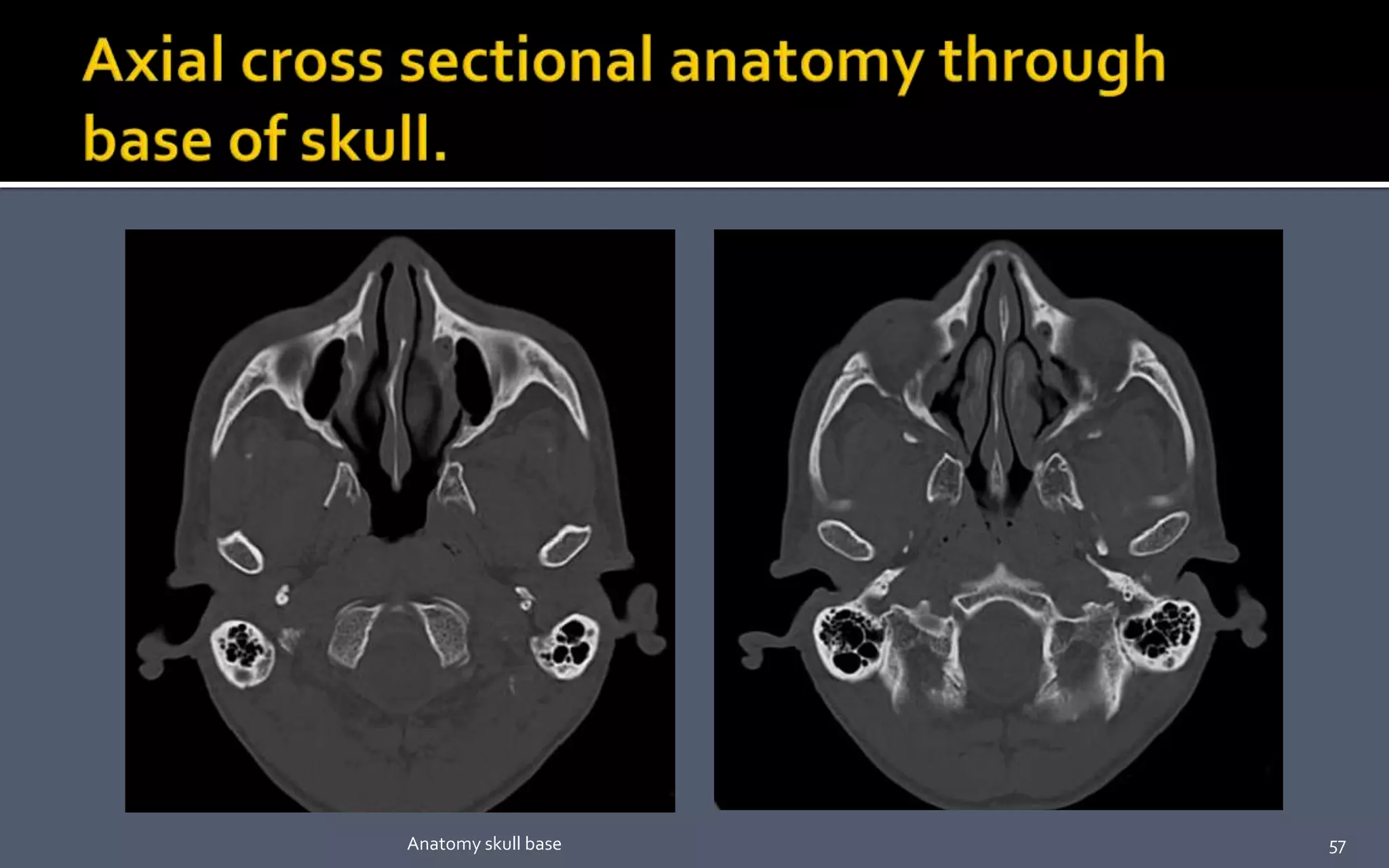 57Anatomy skull base
 