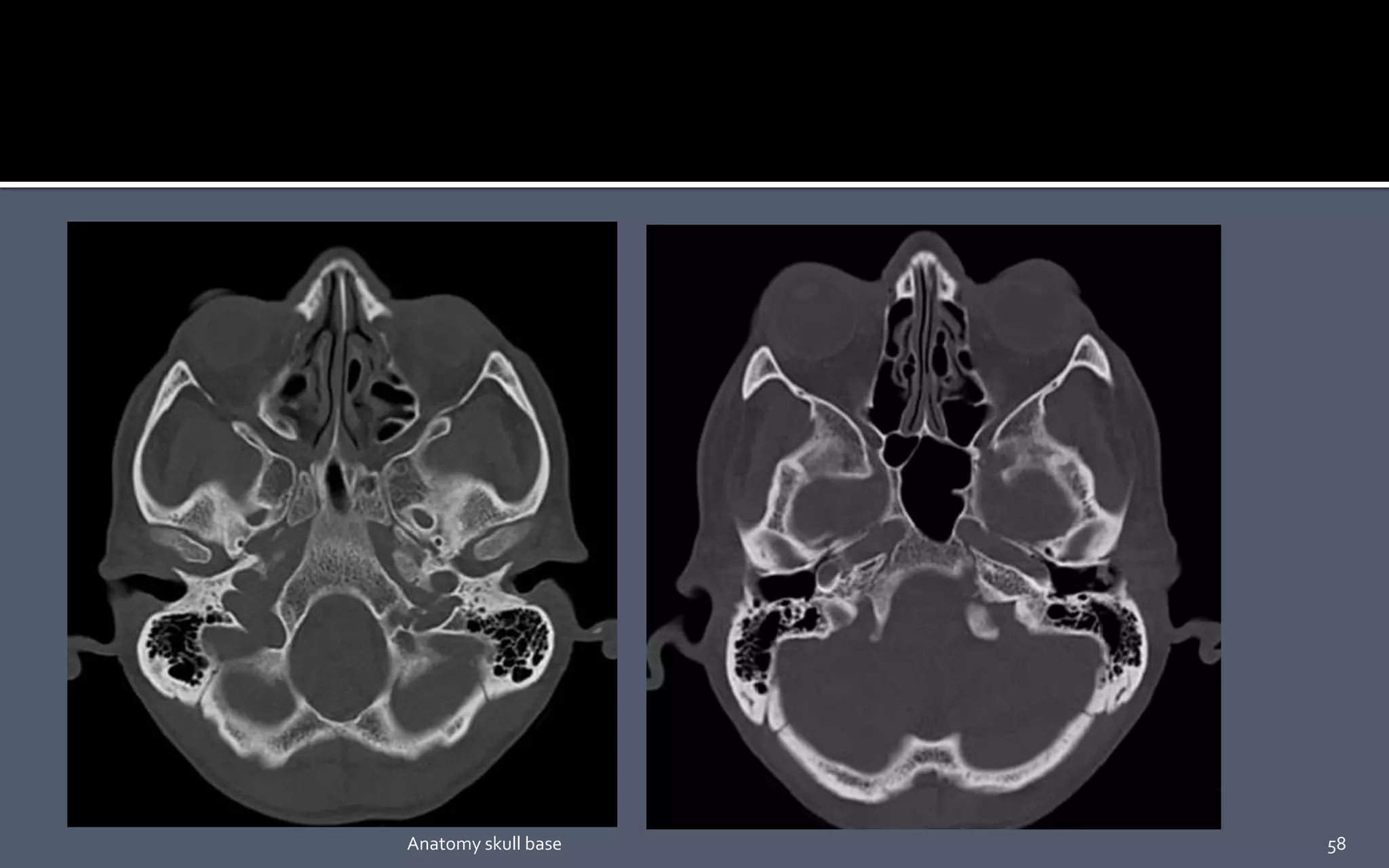 58Anatomy skull base
 