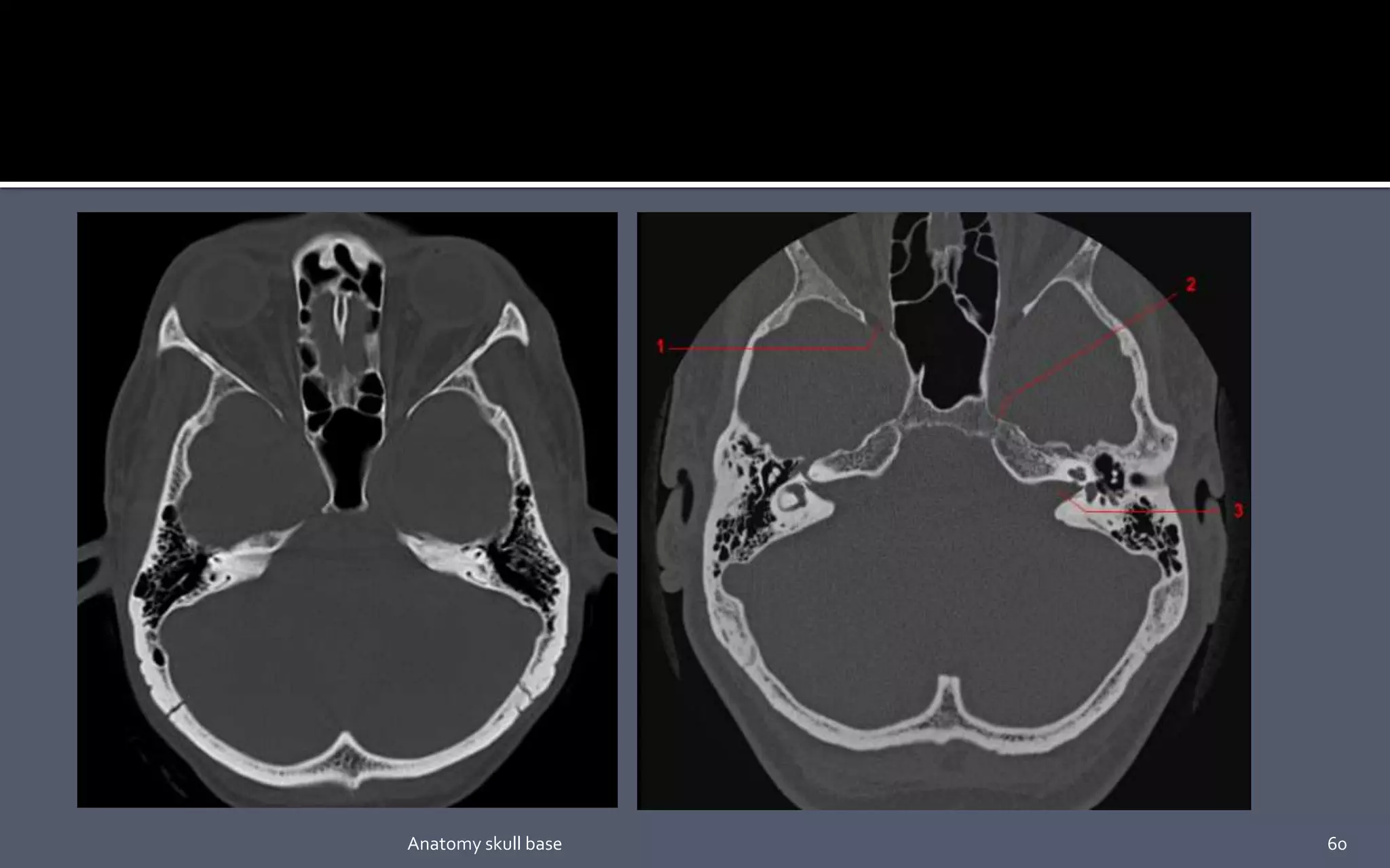 60Anatomy skull base
 