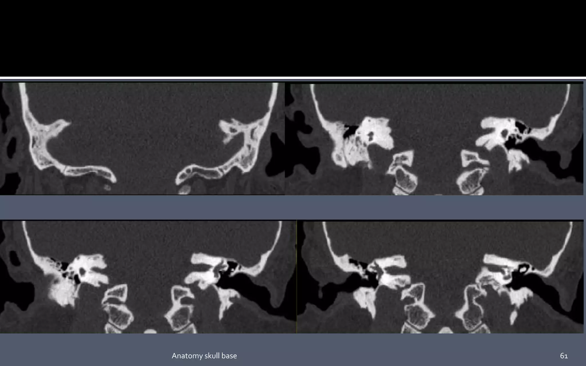 61Anatomy skull base
 
