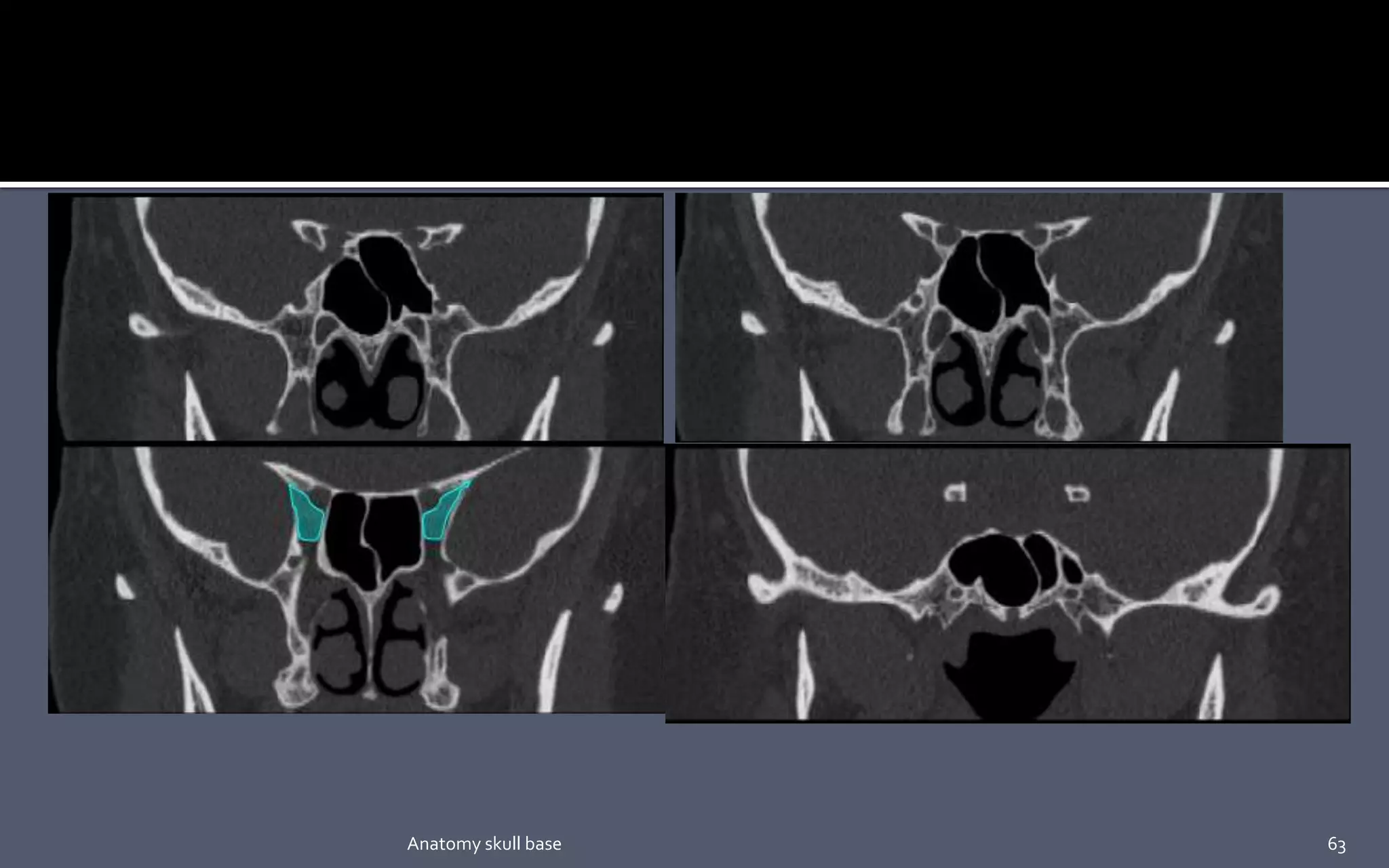63Anatomy skull base
 