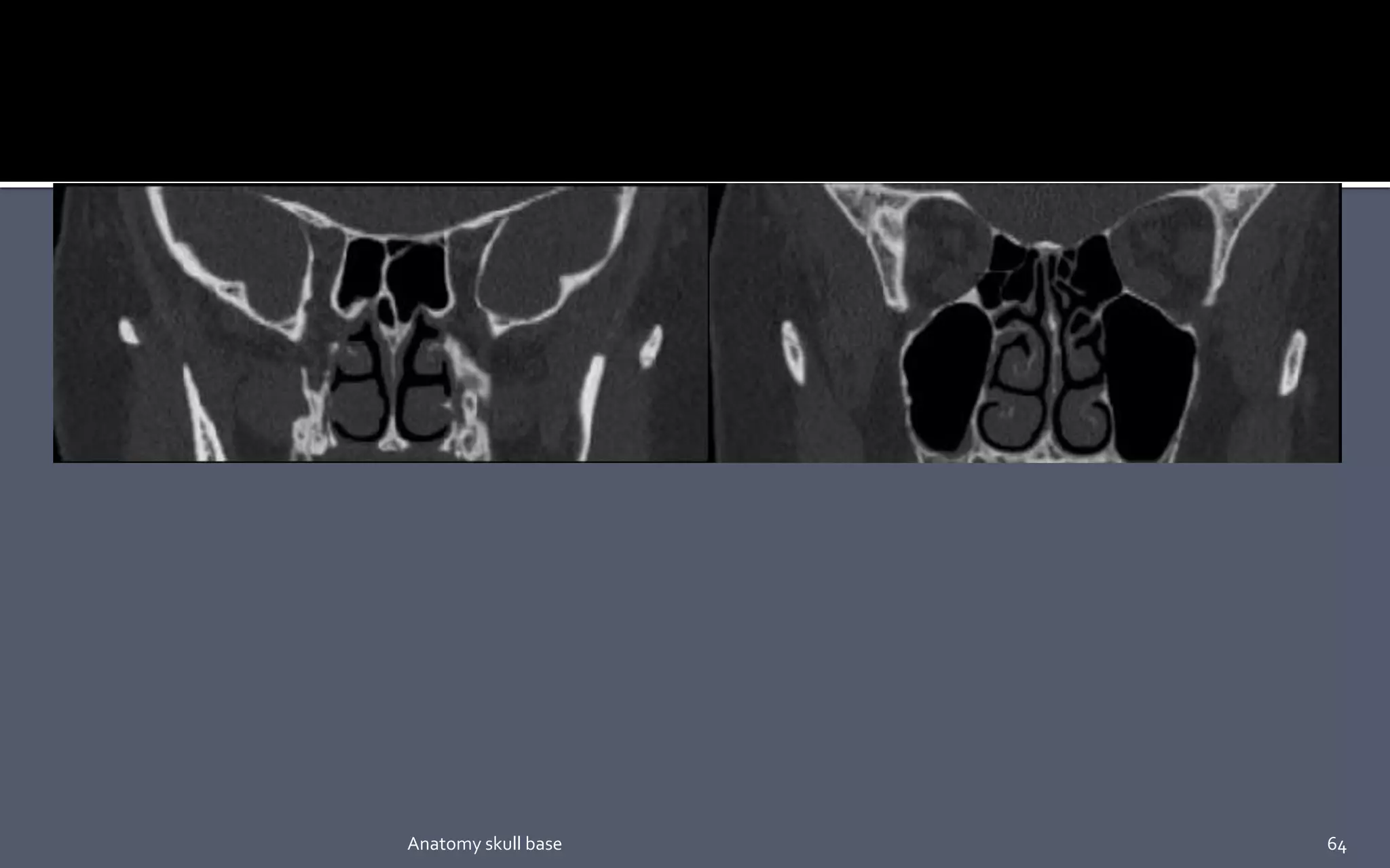 64Anatomy skull base
 