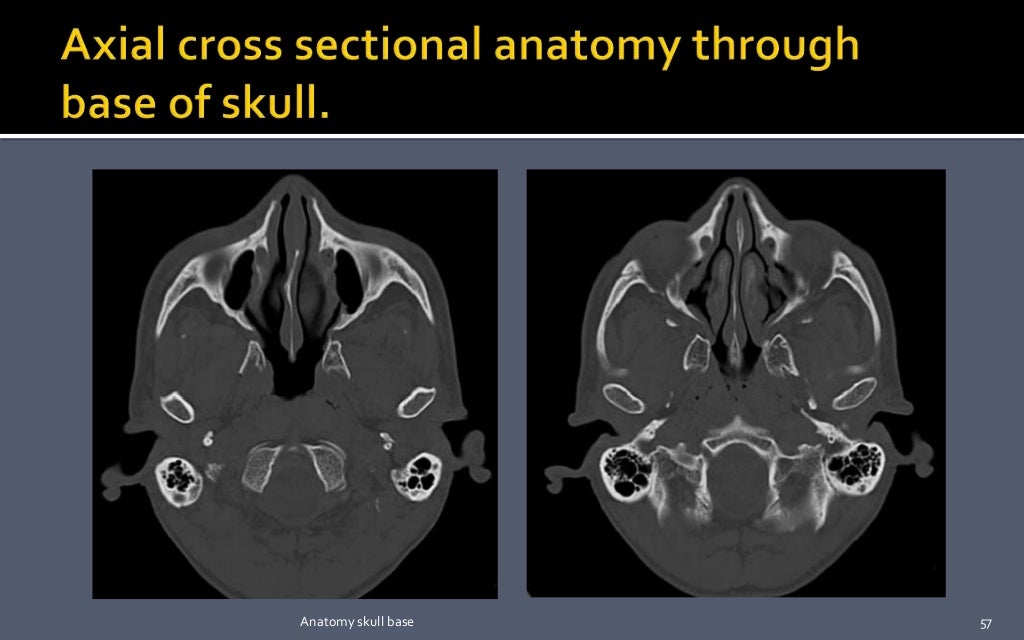 Skull base : Development and anatomy.