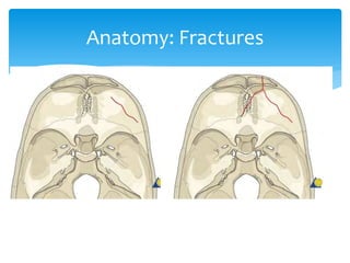 Fractures Base Math Skull Base fractures ( PDFDrive ).pdf