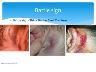 Skull Base fractures ( PDFDrive ).pdf