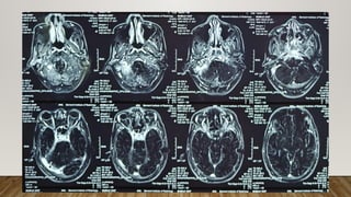 Skull Base osteomyelitis Neuroradio classification, risk factors case ...