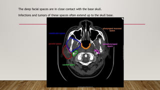 Skull Base osteomyelitis Neuroradio classification, risk factors case ...