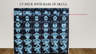 Skull Base osteomyelitis Neuroradio classification, risk factors case ...