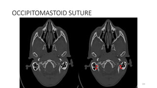 OCCIPITOMASTOID SUTURE
100
 