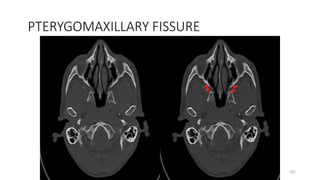 PTERYGOMAXILLARY FISSURE
101
 