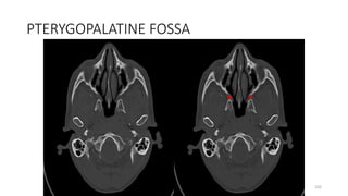 PTERYGOPALATINE FOSSA
102
 