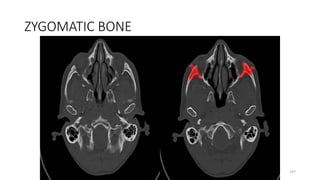 ZYGOMATIC BONE
107
 