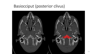 Basiocciput (posterior clivus)
110
 