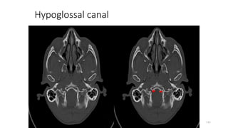 Hypoglossal canal
111
 