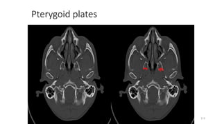 Pterygoid plates
113
 