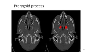 Pterygoid process
114
 