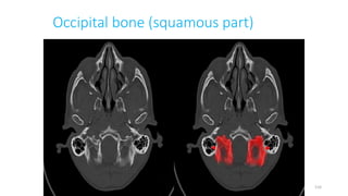 Occipital bone (squamous part)
116
 