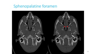 Sphenopalatine foramen
120
 