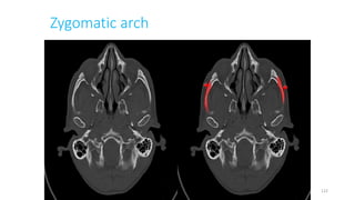 Zygomatic arch
122
 