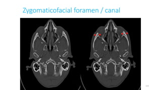 Zygomaticofacial foramen / canal
123
 