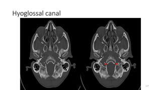 Hyoglossal canal
127
 