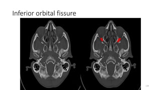 Inferior orbital fissure
128
 