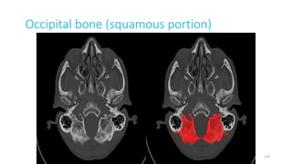 Occipital bone (squamous portion)
129
 