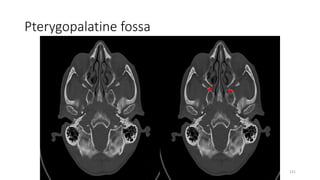 Pterygopalatine fossa
131
 