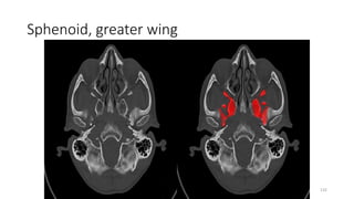 Sphenoid, greater wing
132
 