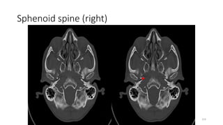 Sphenoid spine (right)
133
 