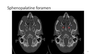 Sphenopalatine foramen
134
 